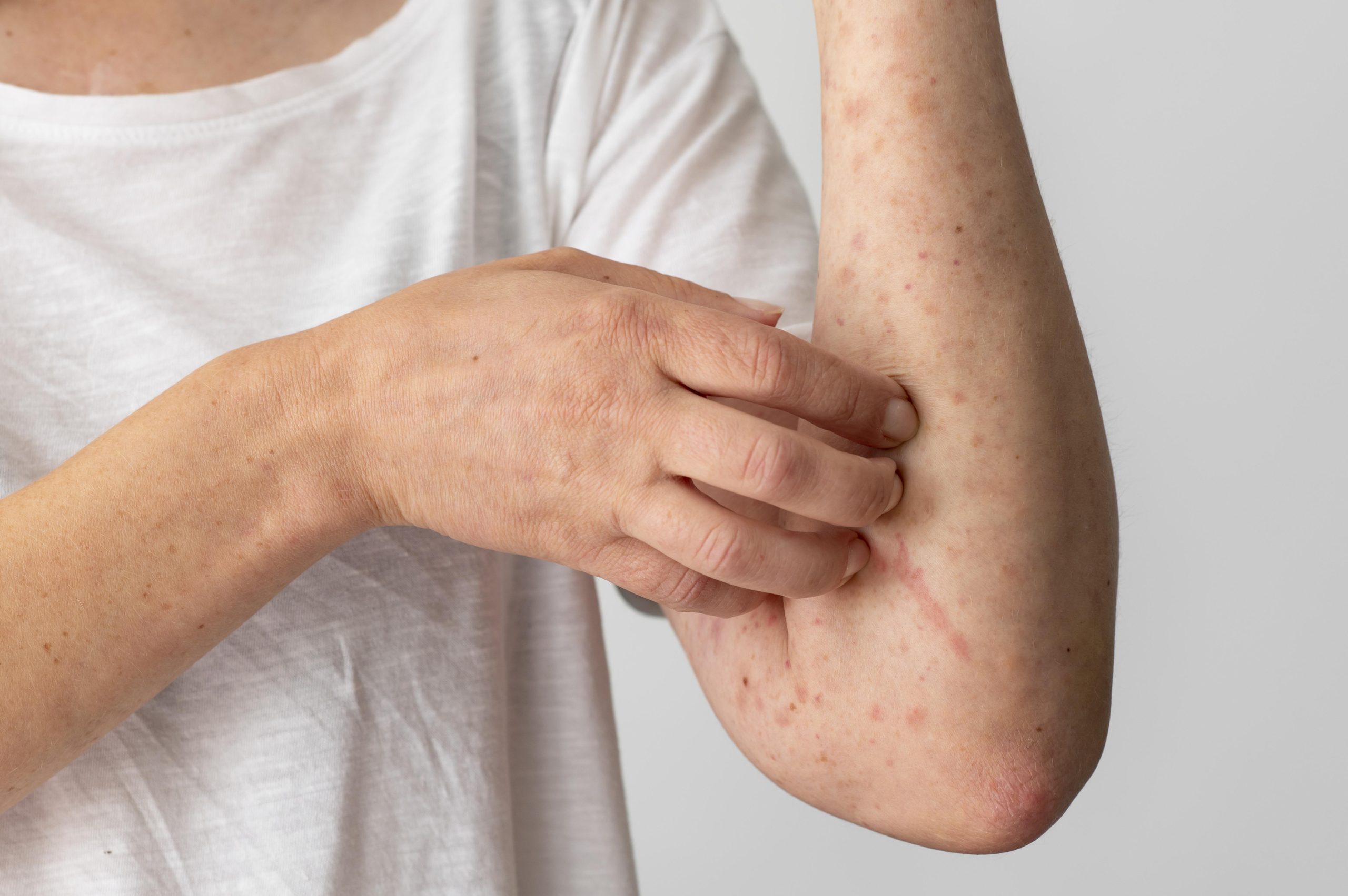Managing Sleep & Reducing Psycho-Emotional Stress for Eczema & Atopic Dermatitis