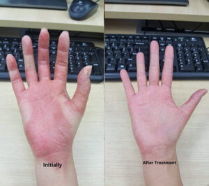 Chinese Medicine Can Treat Pompholyx Eczema