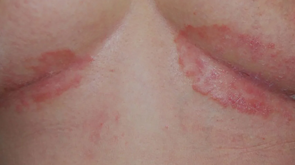 inverse psoriasis type