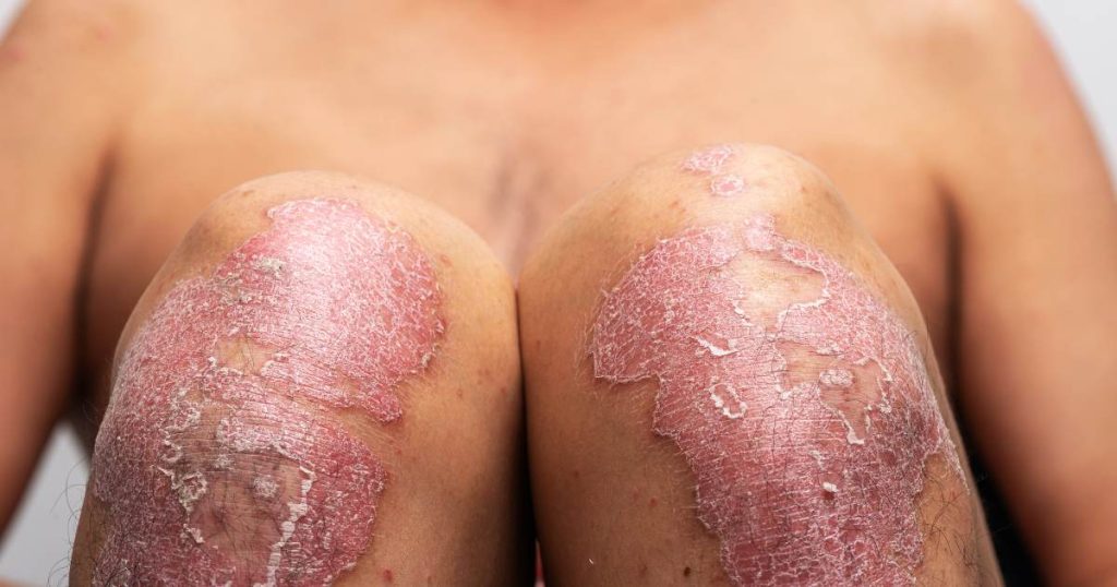 different faces of psoriasis knee psoriasis plaque psoriasis