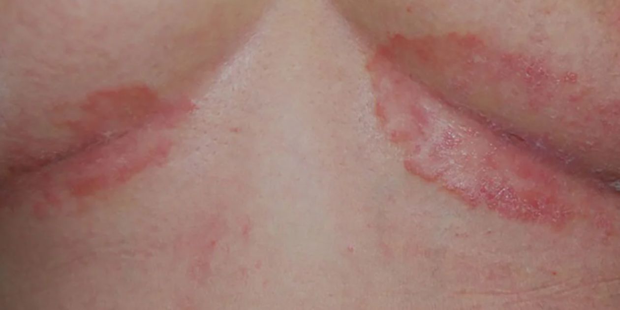 what type of psoriasis do i have