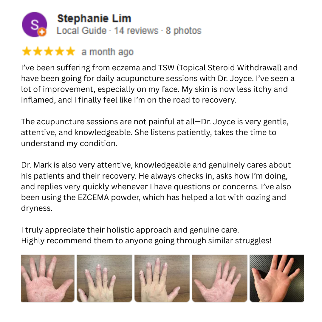 hand eczema singapore eczema powder