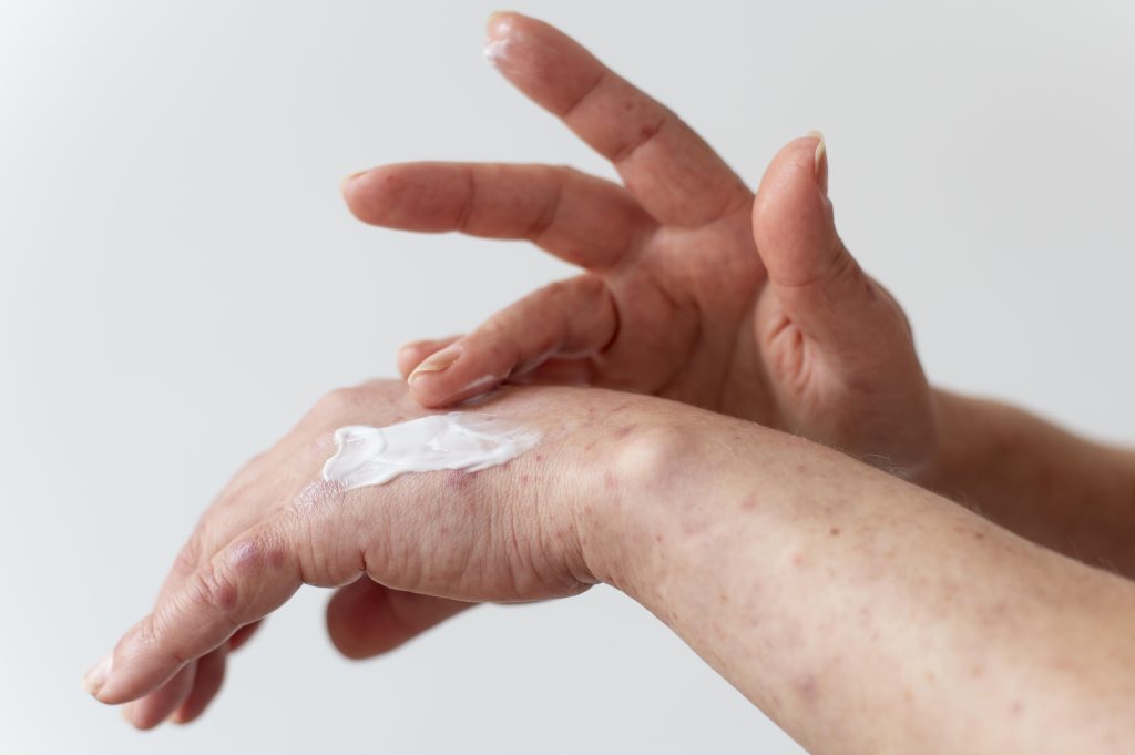 eczema cream, eczema relief cream