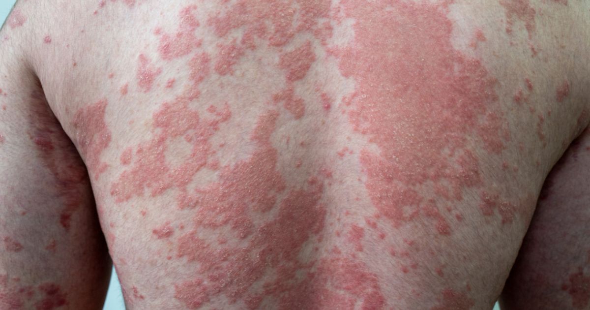 psoriasis self-care