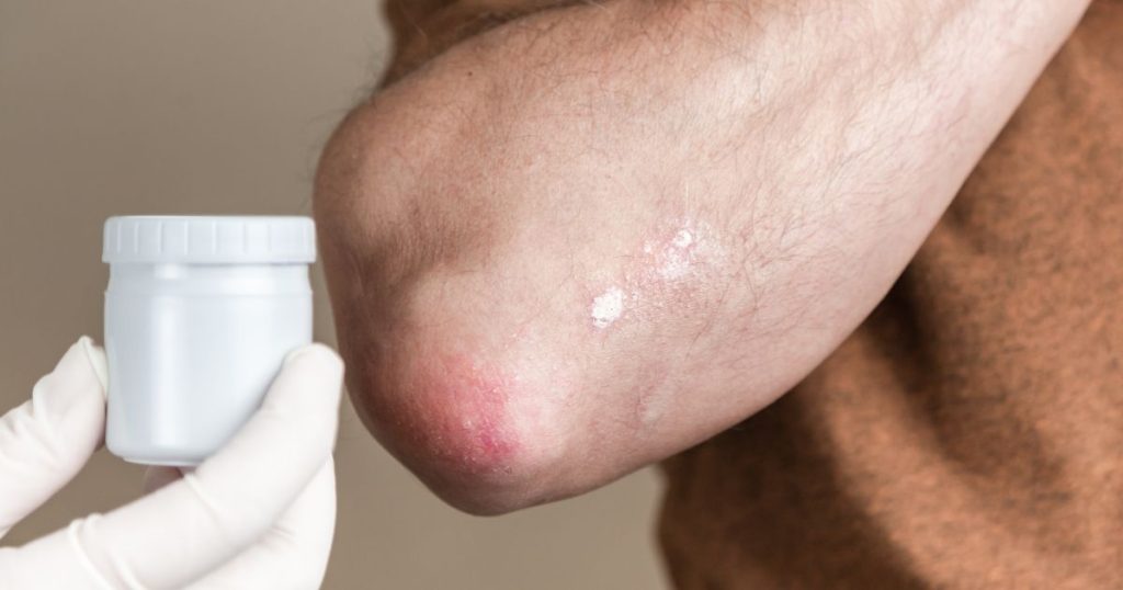self-care psoriasis