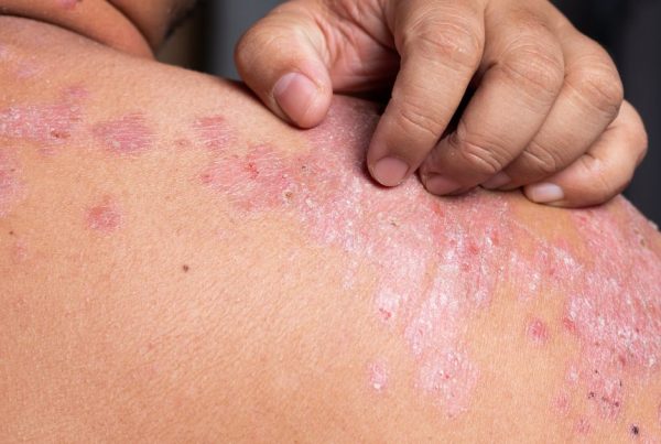 psoriasis locations