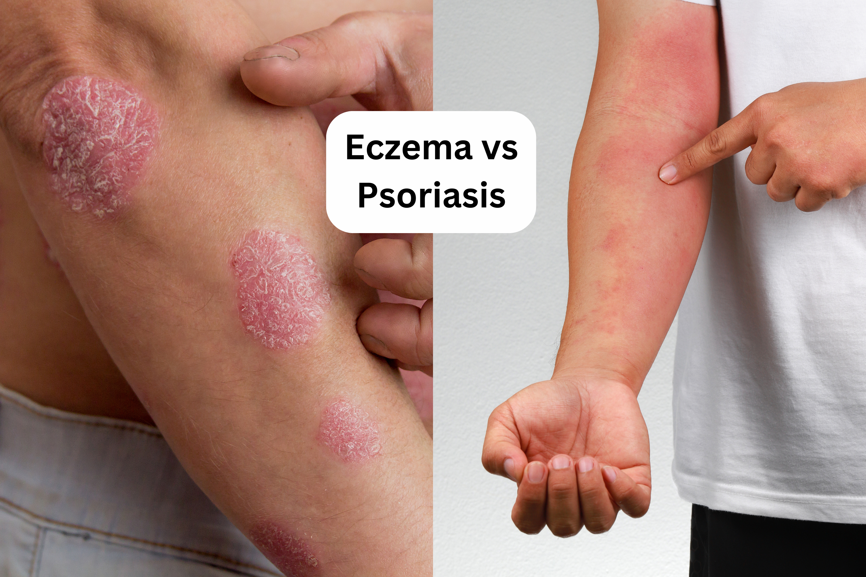 eczema vs psoriasis