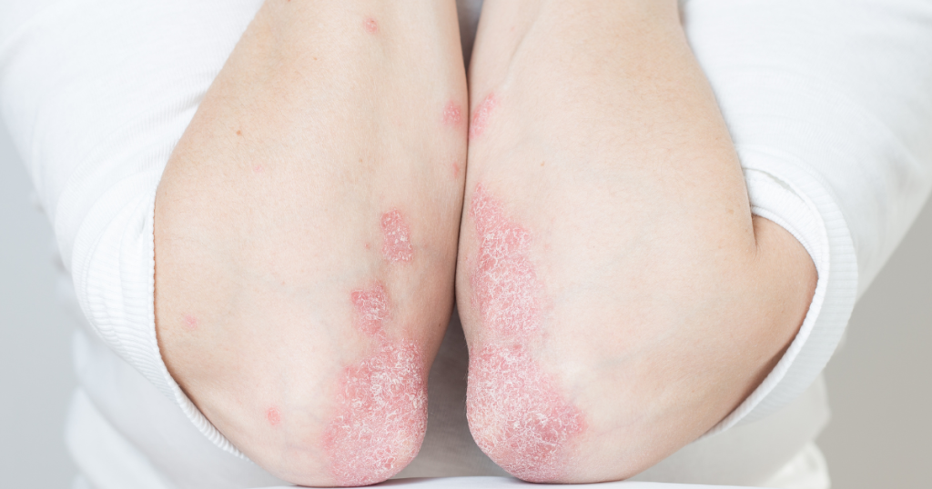 tcm psoriasis treatment chinese doc singapore