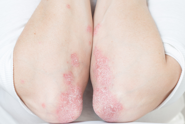 tcm psoriasis treatment chinese doc singapore