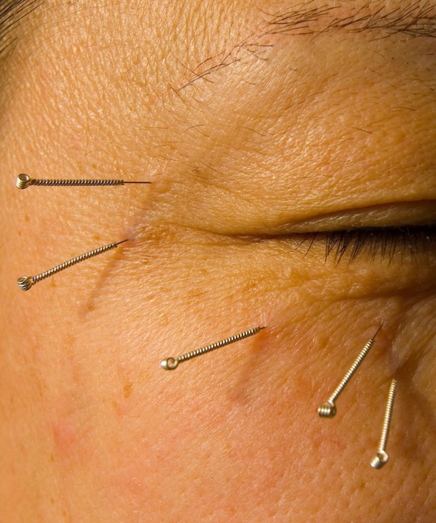 acupuncture for thyroid eye disease
