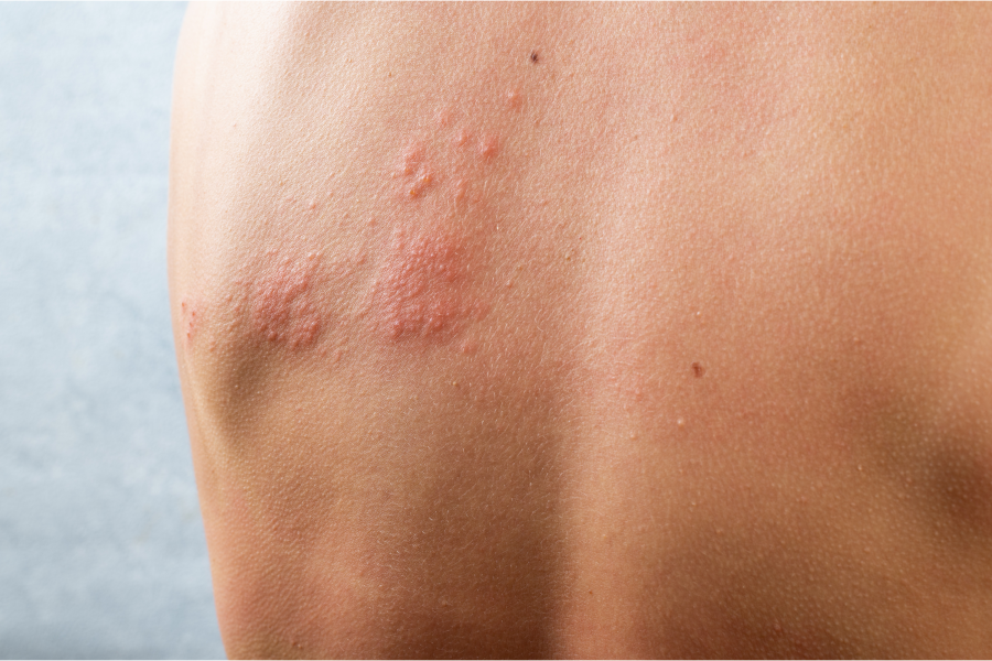 Why Should I Get TCM Treatment for Shingles