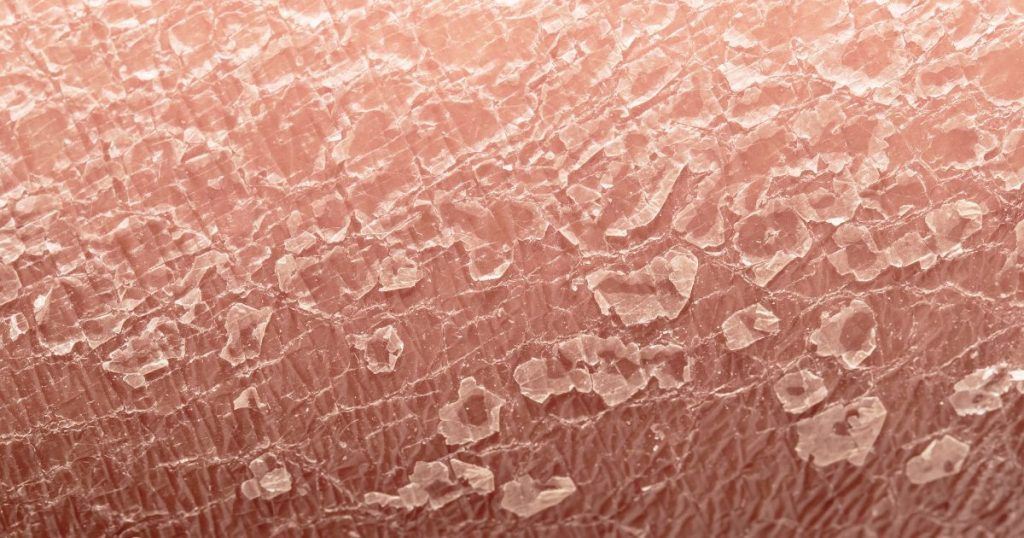 cap treatment, cap therapy for tsw recovery