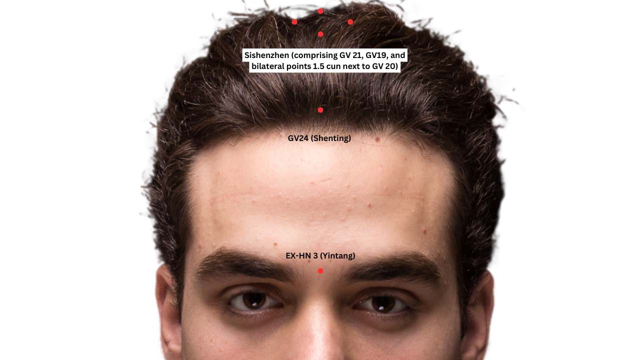 scalp acupuncture points for parkinsons disease