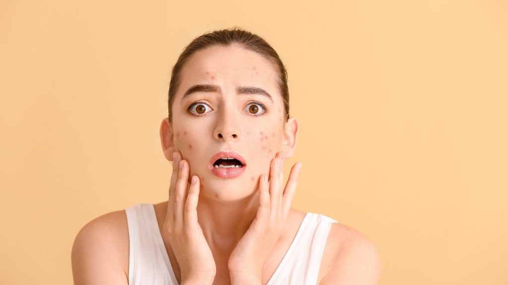 acupuncture points for cystic acne on temples