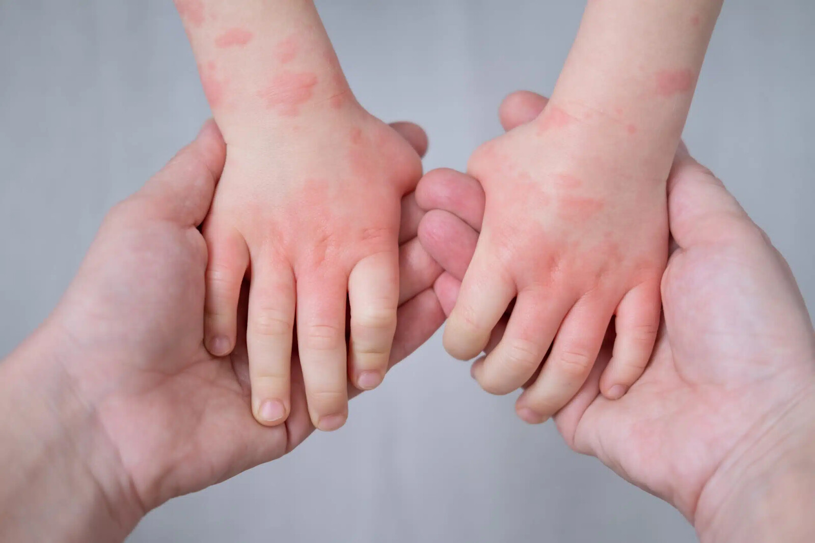probiotics for kids eczema