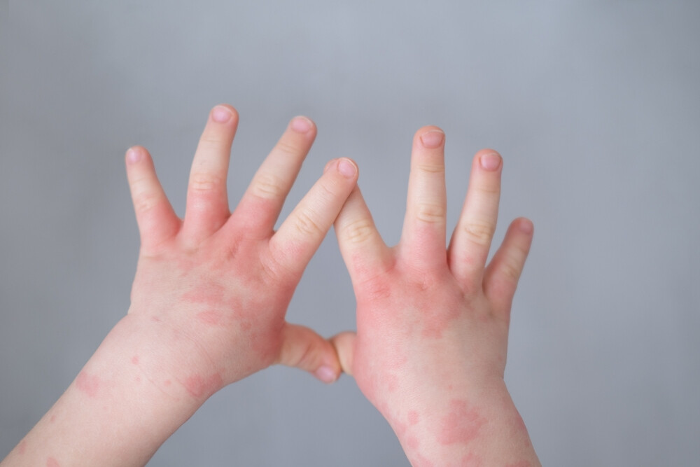 probiotics for kids eczema