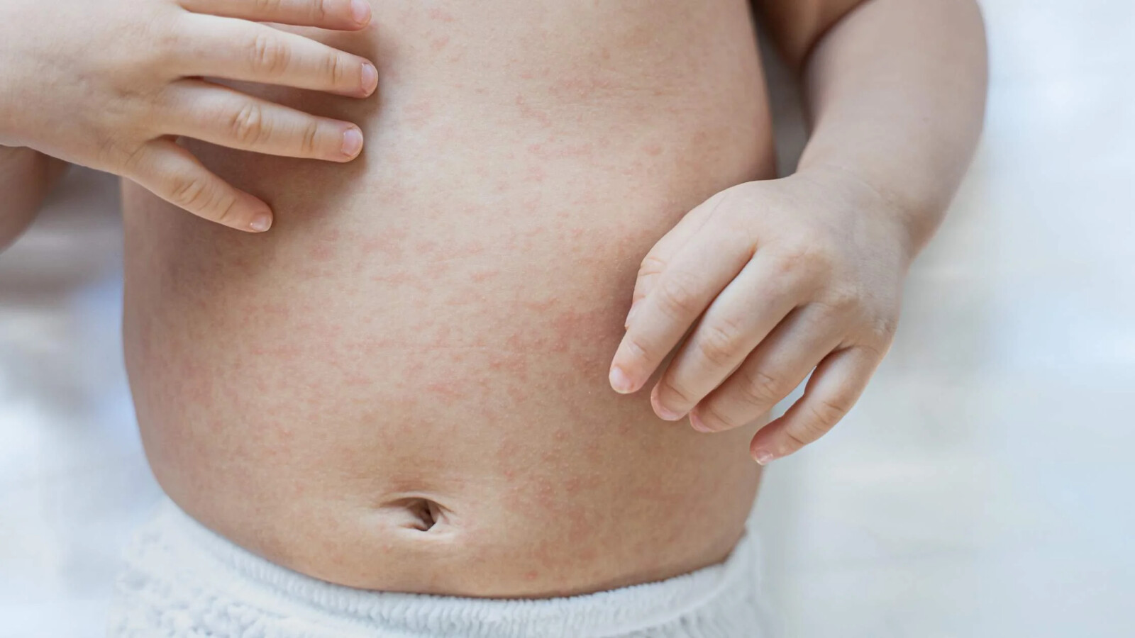 probiotics for kids eczema