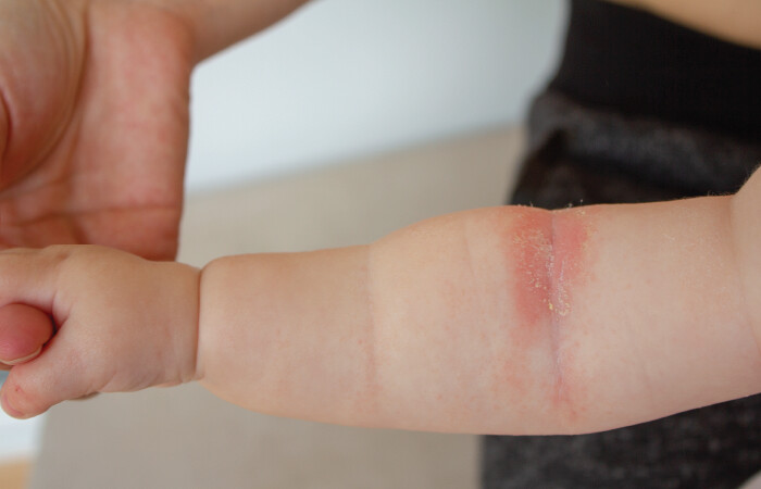 Is the Probiotics I’m Giving My Child Making Their Eczema Worse?