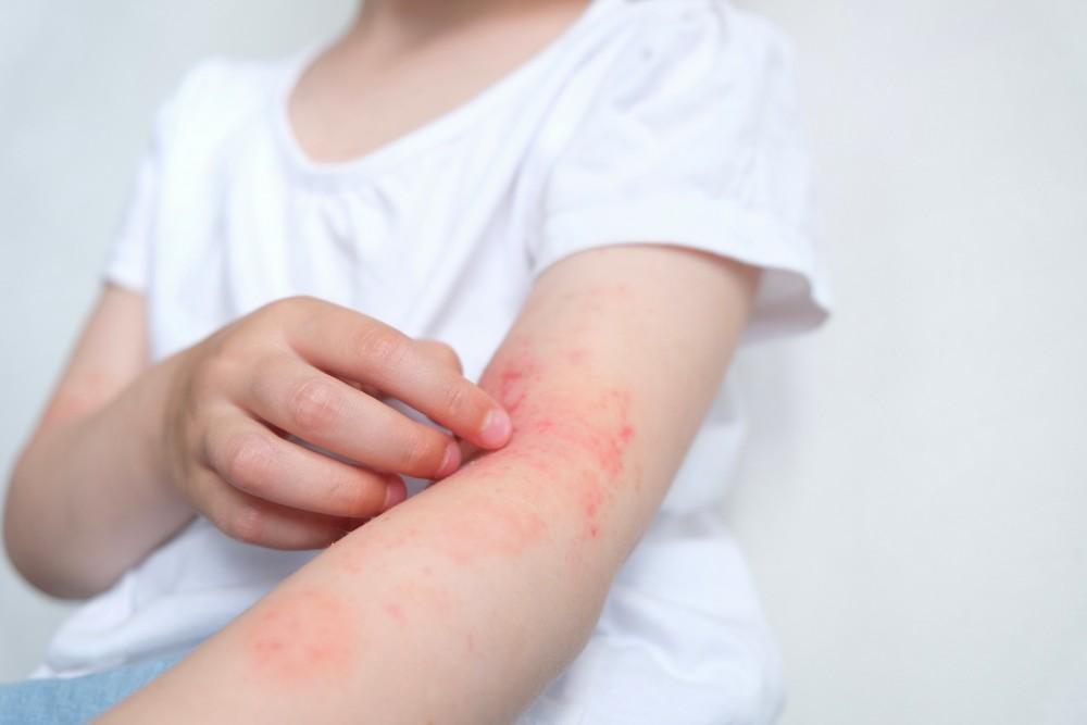 probiotics for kids eczema
