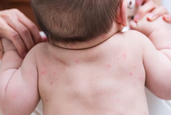 infant baby skin rash