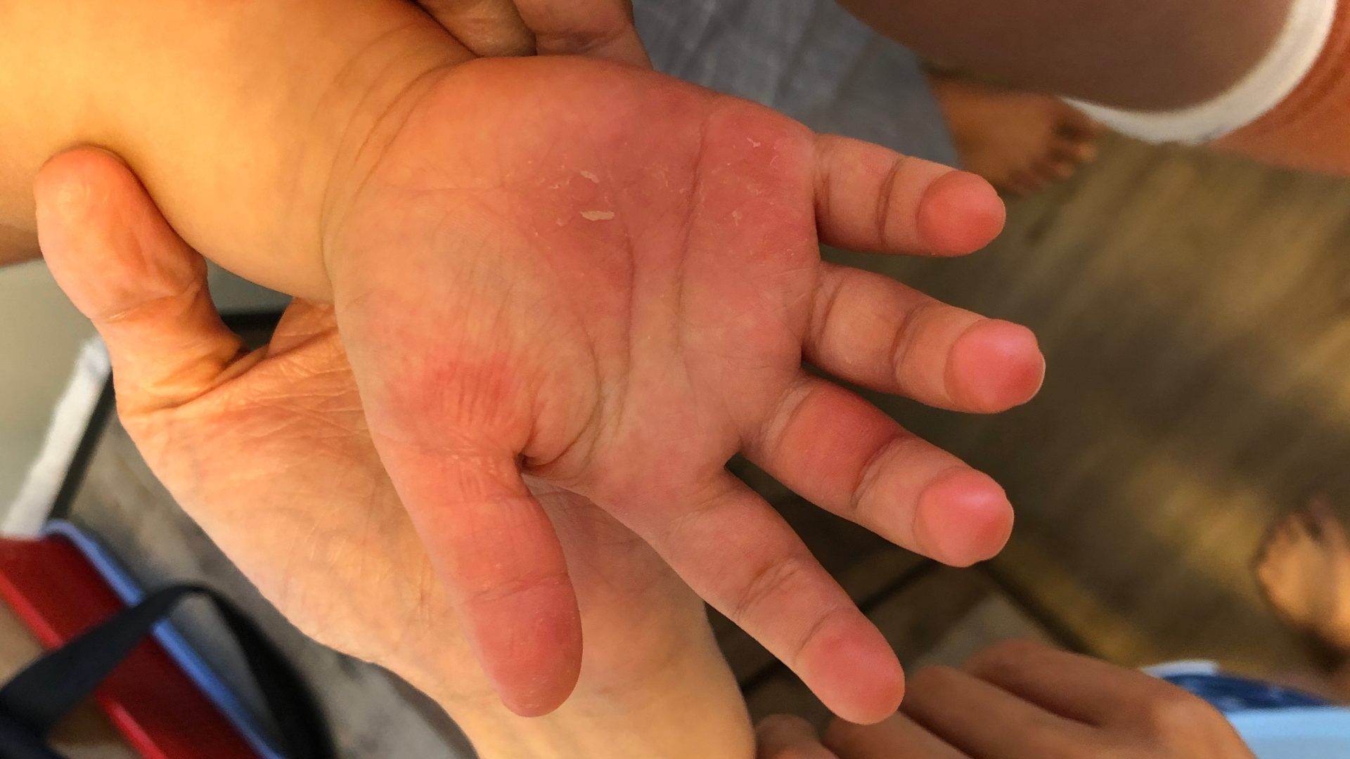 Lactobacillus Probiotic for Kids with Eczema: Our Take on LactoGG & More